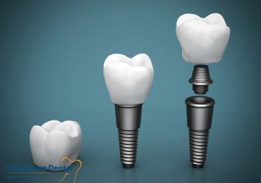 dental implant surgery Chadstone Dental