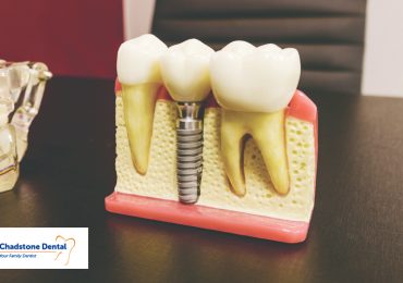 Blog 9 cosmetic dental implants Chadstone Dental